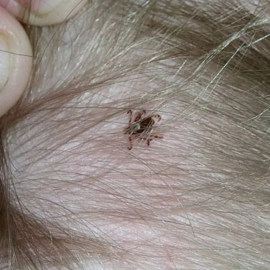 Can Humans Get Ticks in Their Hair Like Lice?