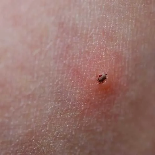 small spider bite on inflammed skin
