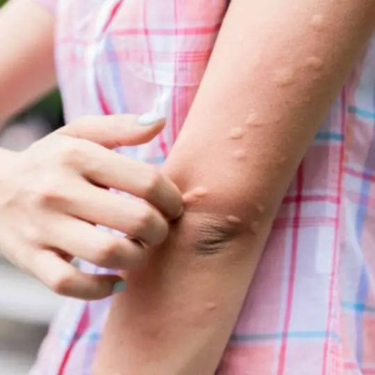 mosquito bites on arm
