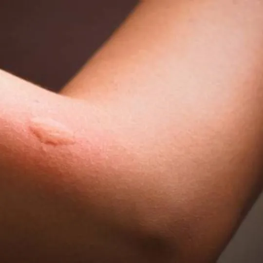 bug bite on human arm