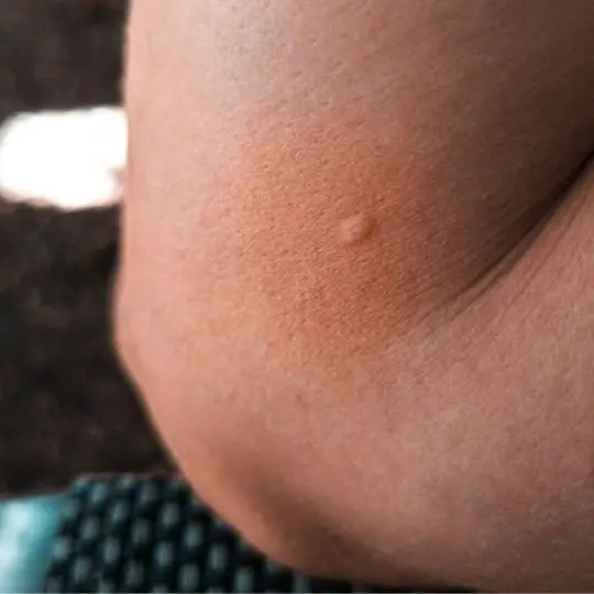 close up of human skin with spider bite