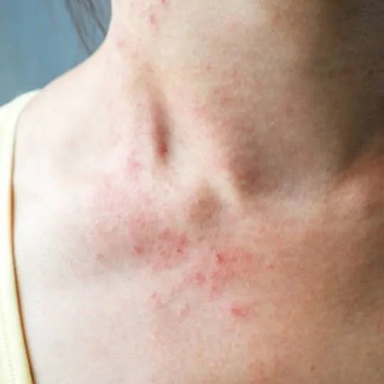 skin irritation around the neck area
