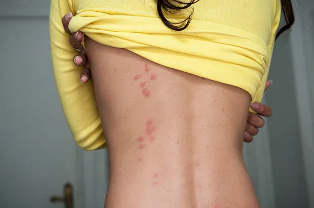 red bites on back of woman