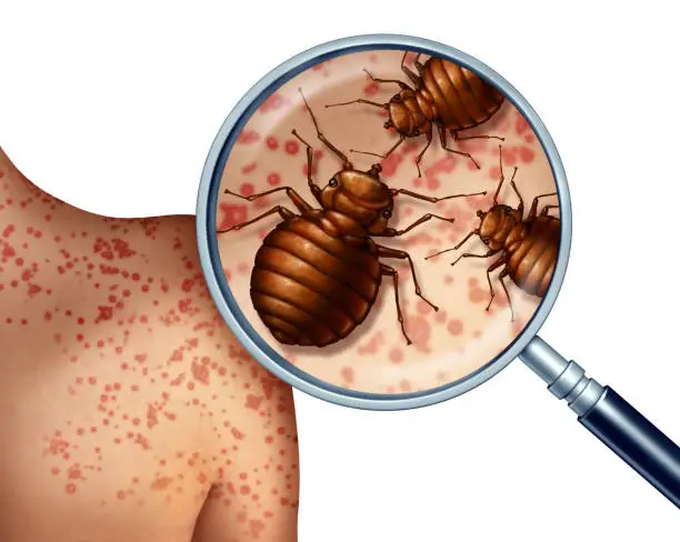 Bed bug bites on human skin or bedbug infestation concept as a magnification close up of parasitic insect pests as a hygiene symbol and health danger of bloodsucking parasites