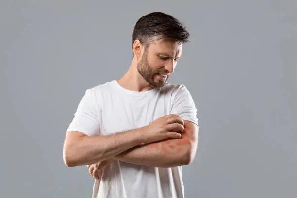 Dermatitis, eczema, allergy, psoriasis concept. Annoyed middle-aged man in white t-shirt scratching itch on his arm, grey studio background. Bearded man itching rash on his elbow,